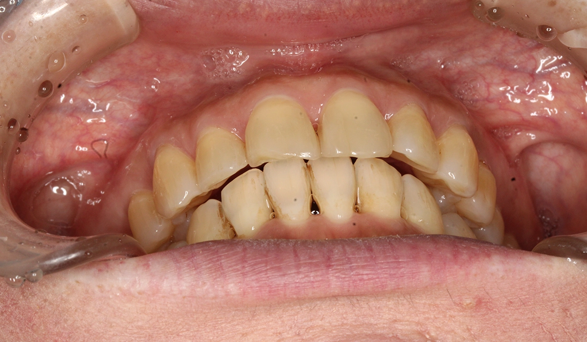 術後:前歯部あおり