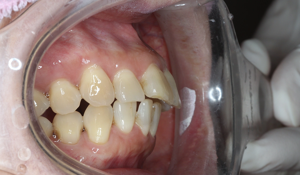 術前:オーバージェット