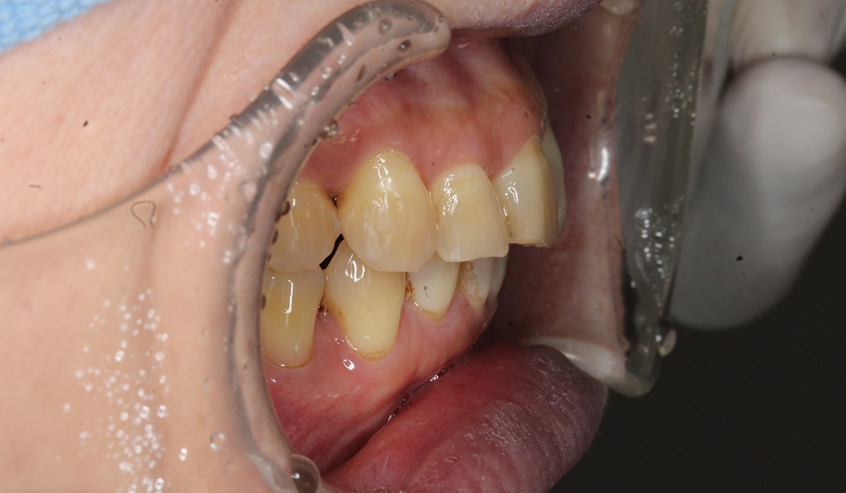 術後:オーバージェット