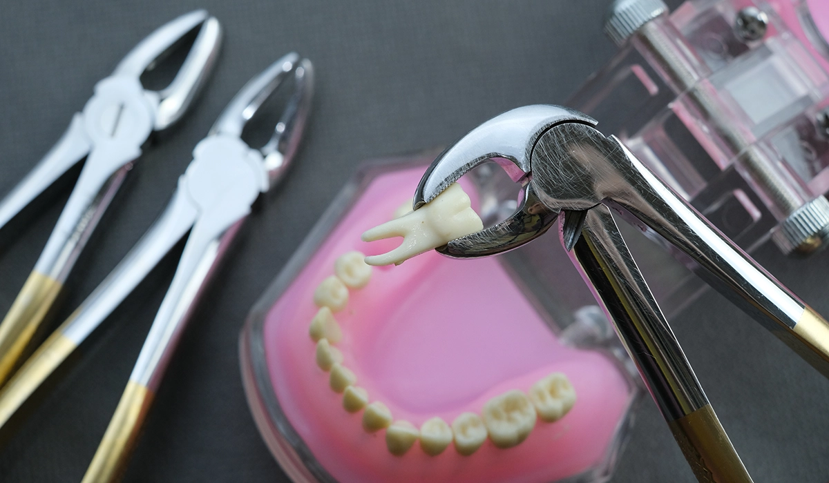 インビザライン治療で親知らずの抜歯が不要なケース