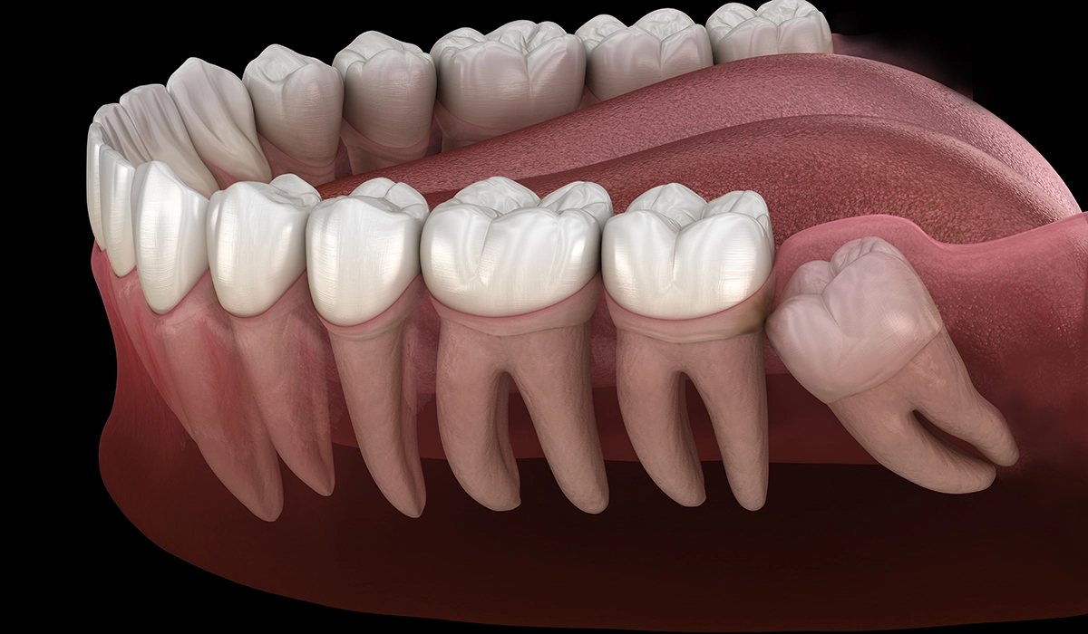 インビザライン治療で親知らずを抜歯するデメリット・リスク