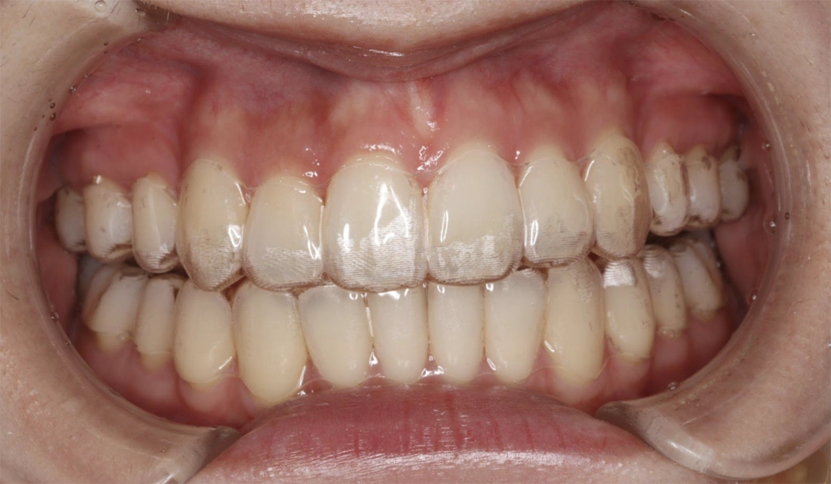 マウスピースタイプ