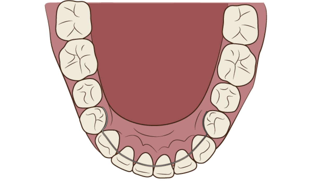 ワイヤータイプ