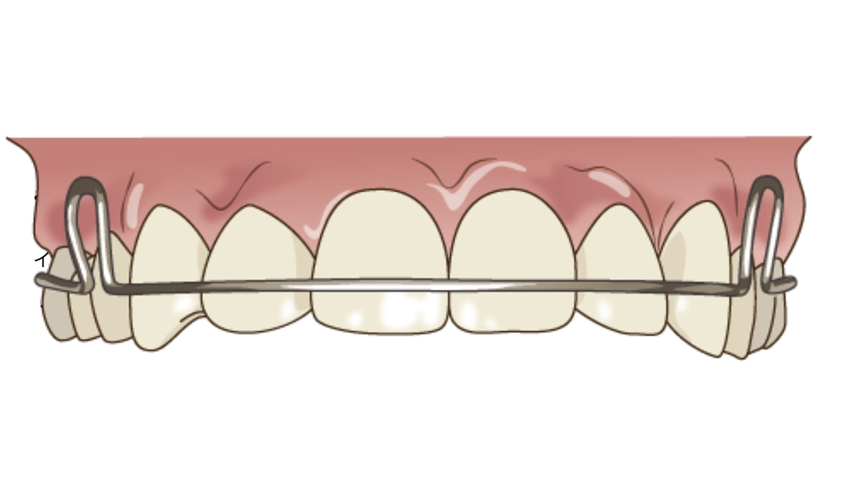 プレートタイプ