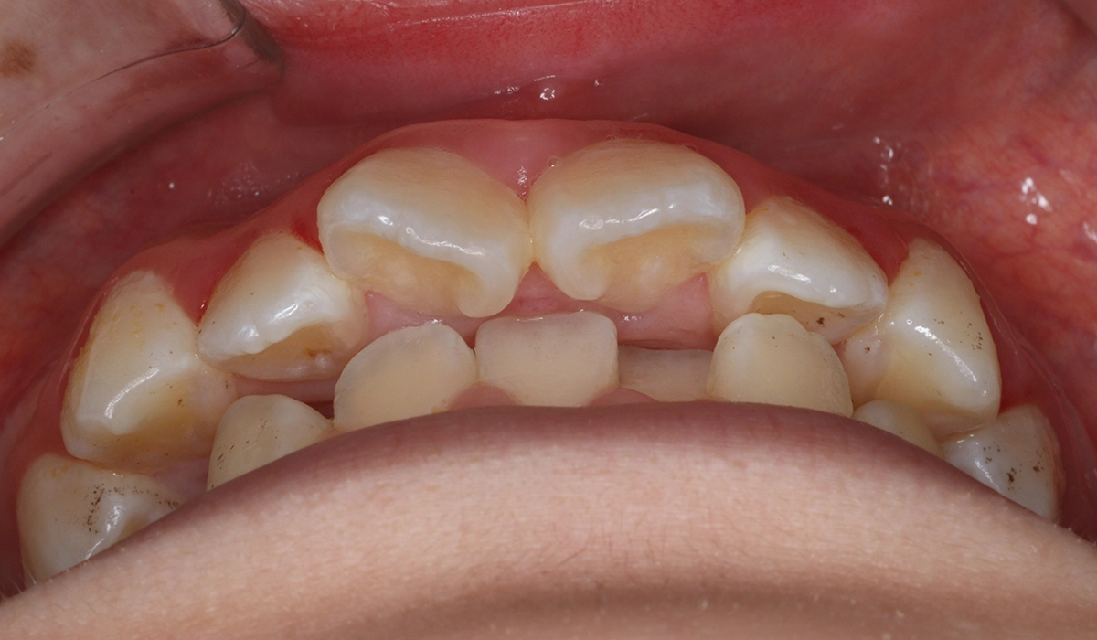 術前:前歯部あおり