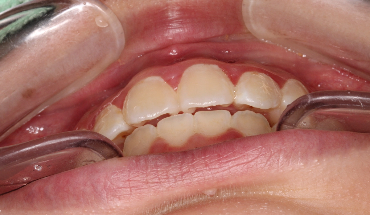 術後:前歯部あおり