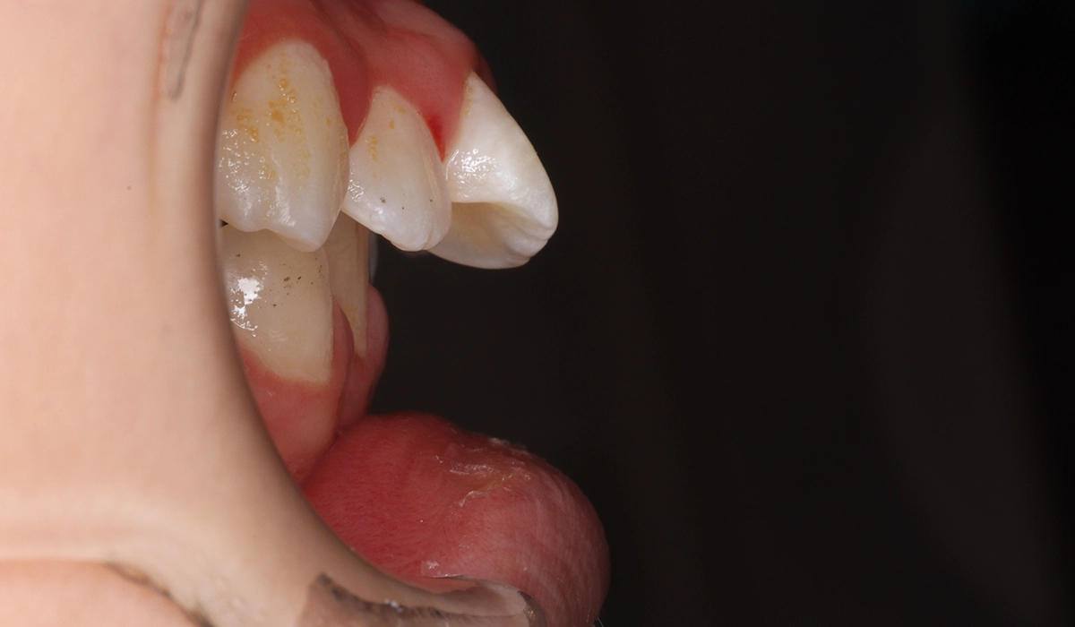 術前:オーバージェット