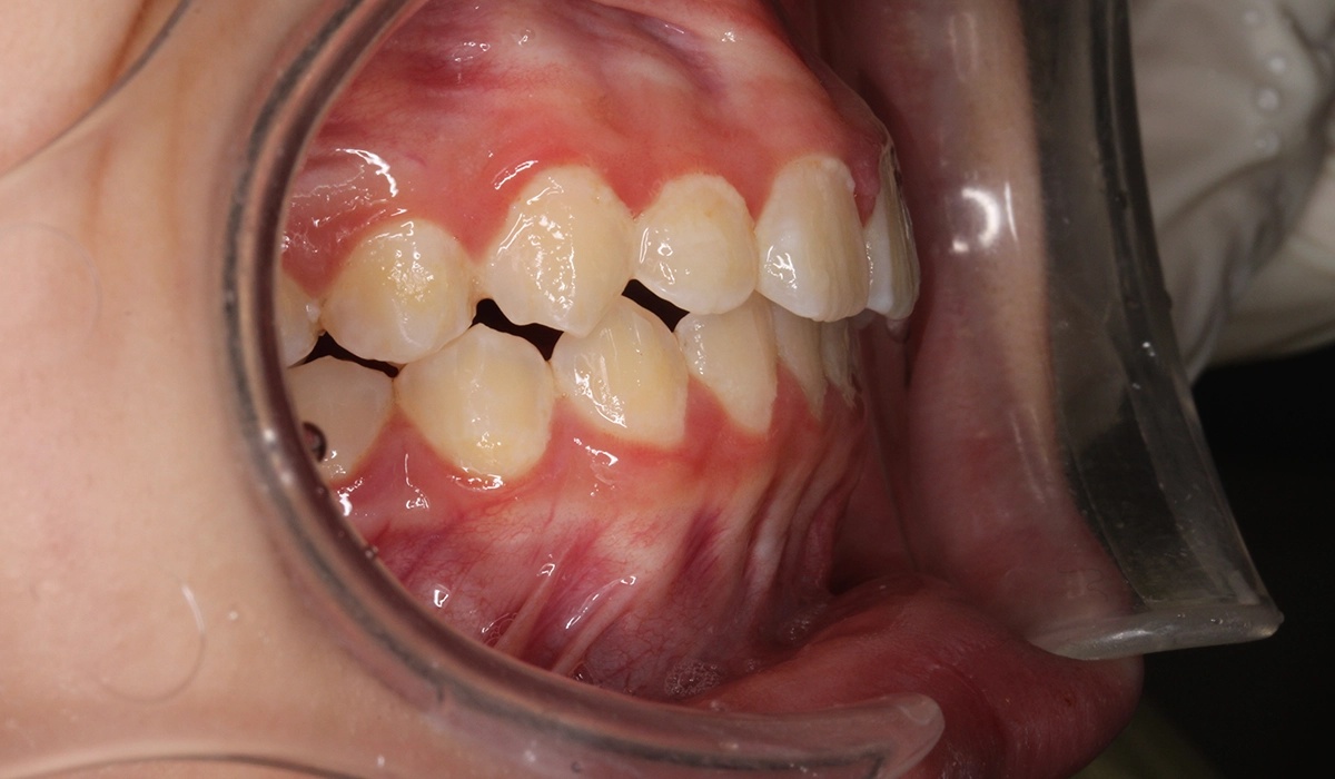 術後:オーバージェット