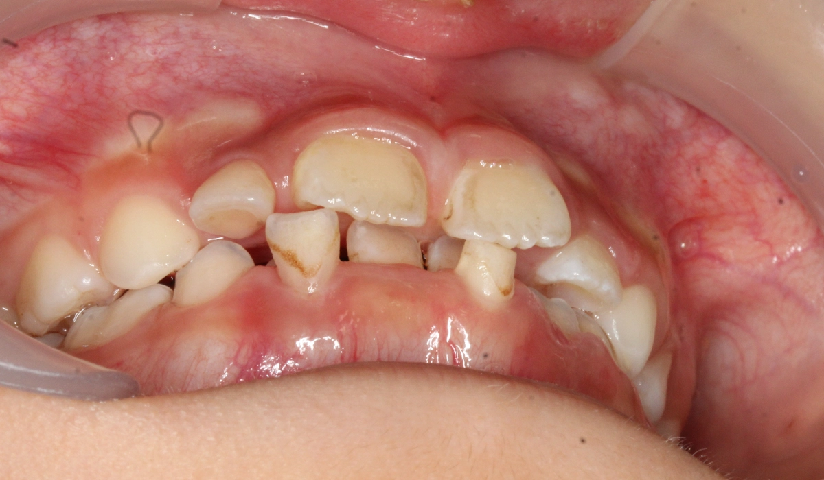 術前:前歯部あおり