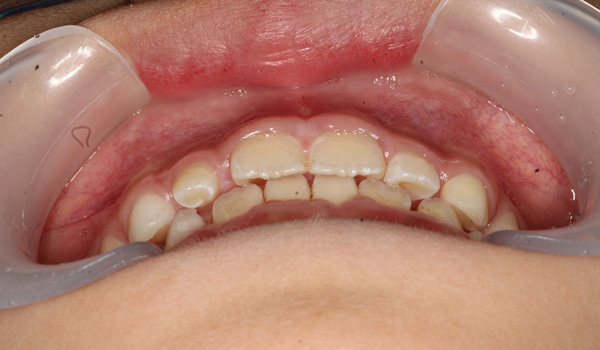 術後:前歯部あおり