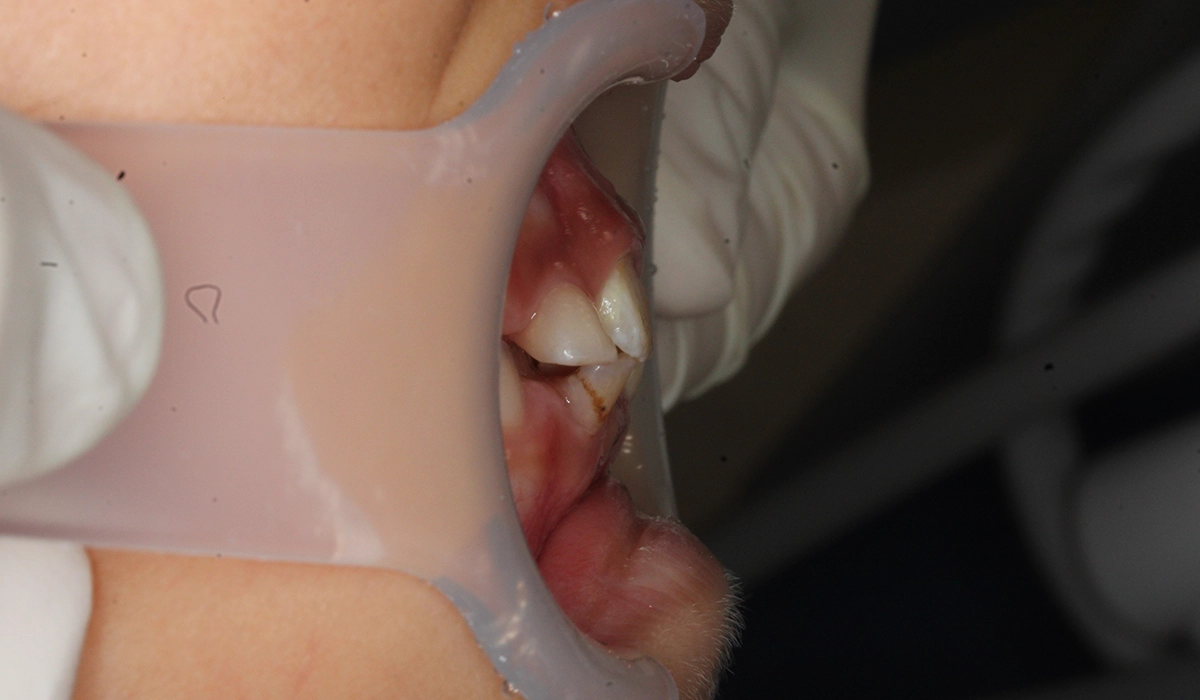 術前:オーバージェット