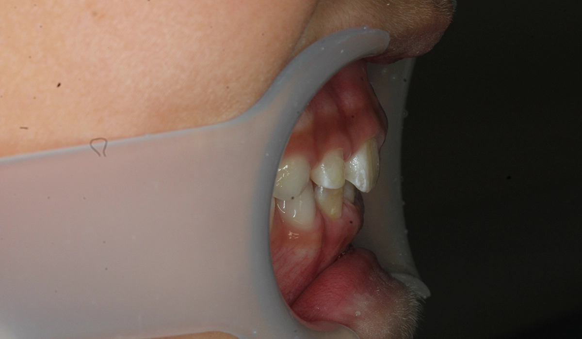 術後:オーバージェット