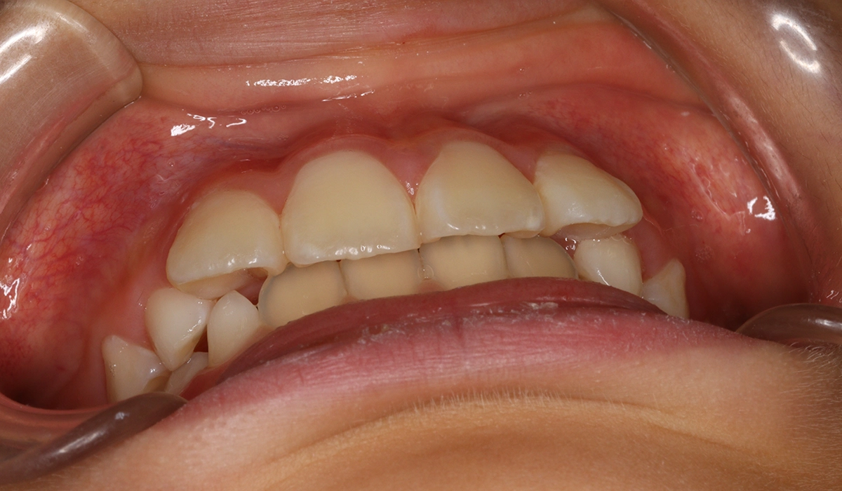 術前:前歯部あおり