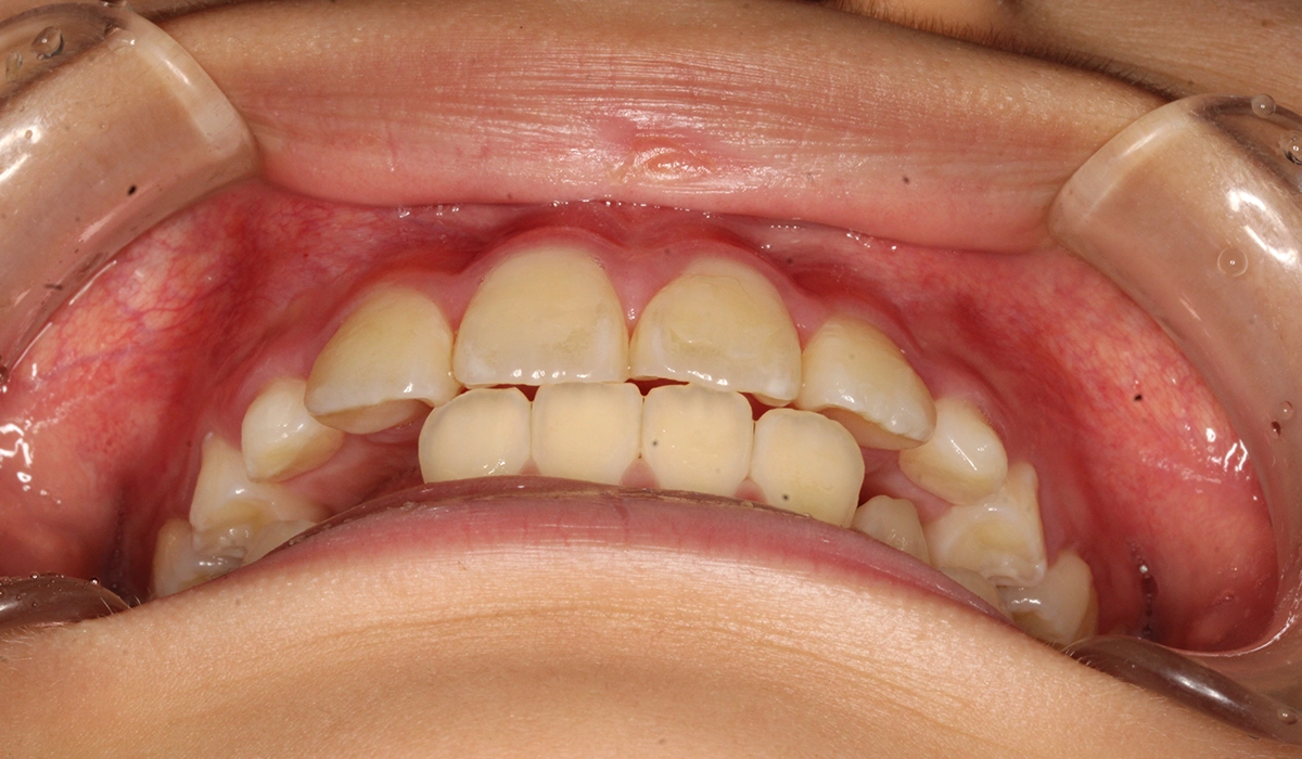 術後:前歯部あおり