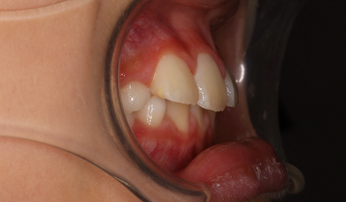 術前:オーバージェット