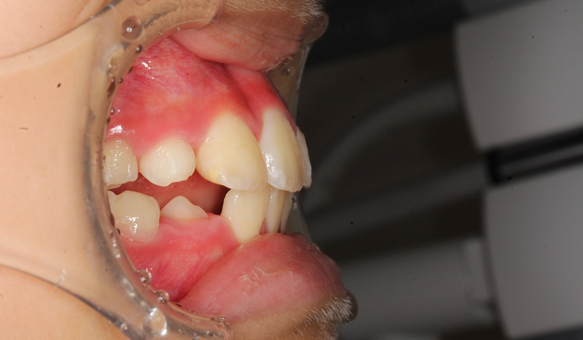 術後:オーバージェット