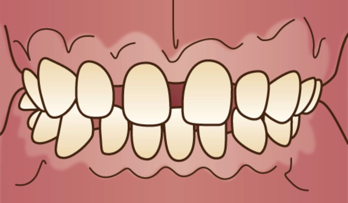 そもそもすきっ歯とは
