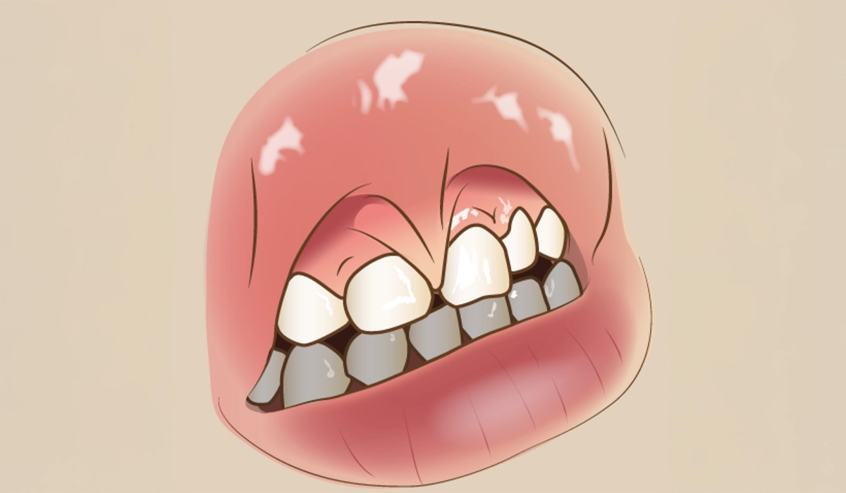 上唇小帯に起因するもの