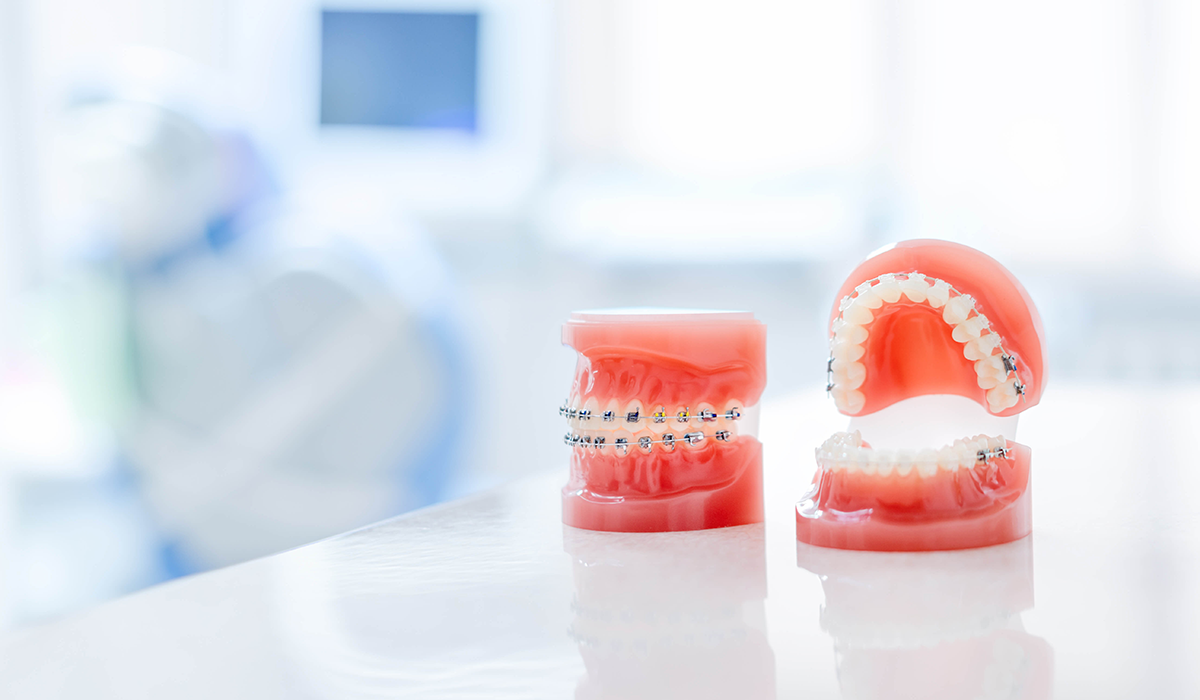 ワイヤー矯正とは