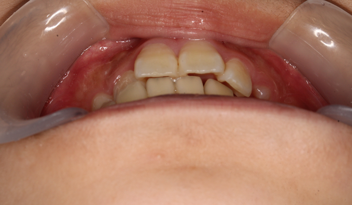 術前:前歯部あおり