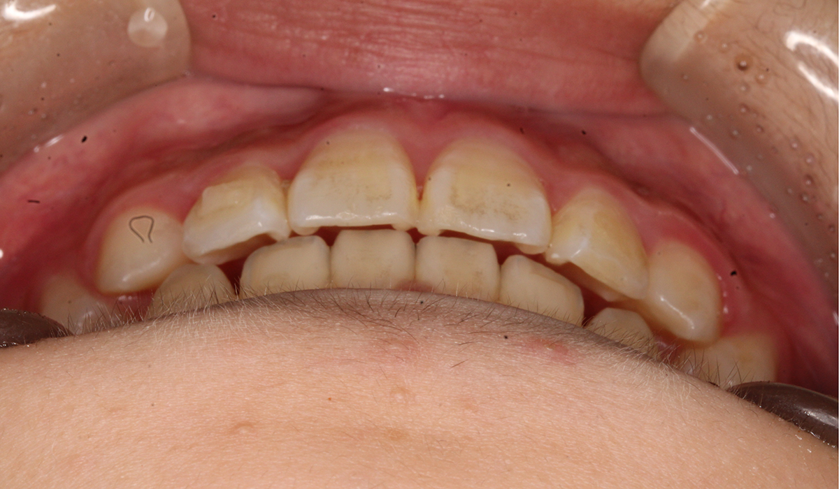 術後:前歯部あおり