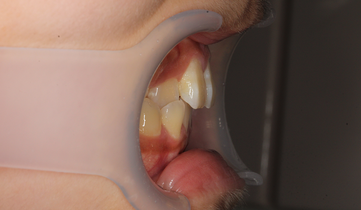 術前:オーバージェット