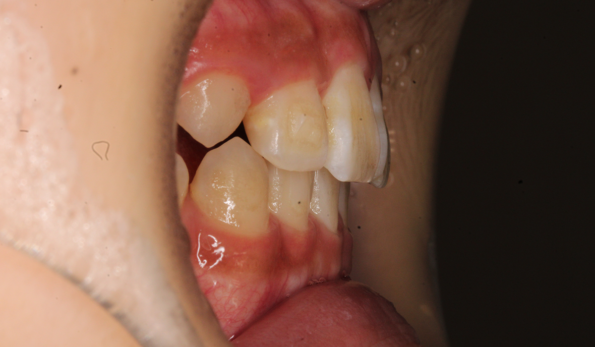 術後:オーバージェット