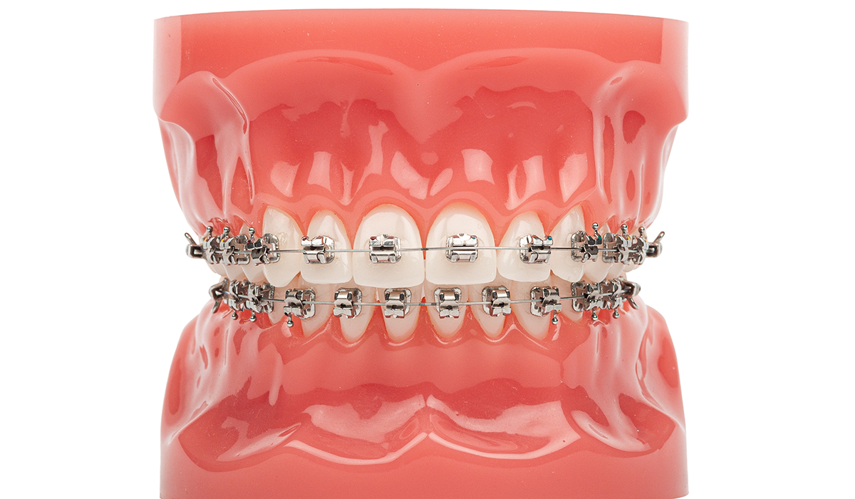 ワイヤー矯正のメリット・デメリット