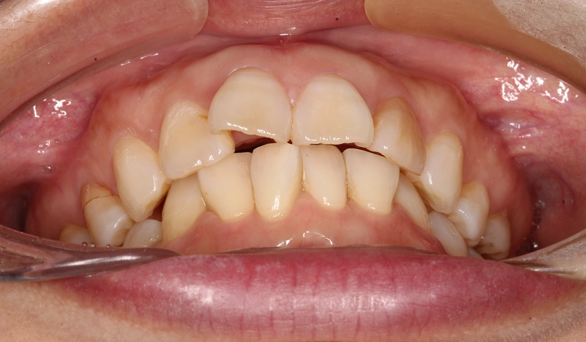 術前:前歯部あおり