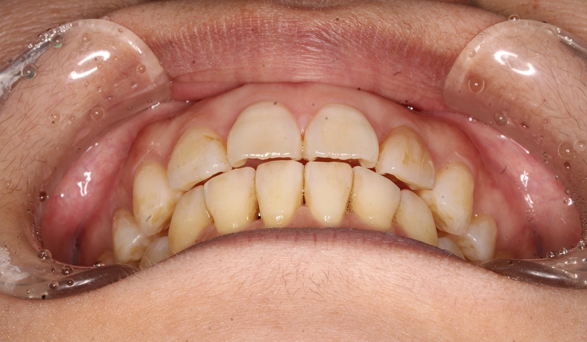 術後:前歯部あおり