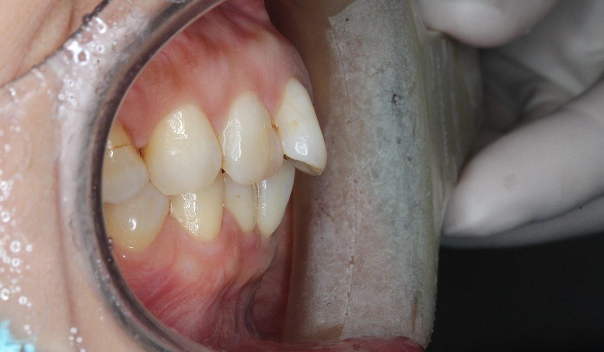 術前:オーバージェット