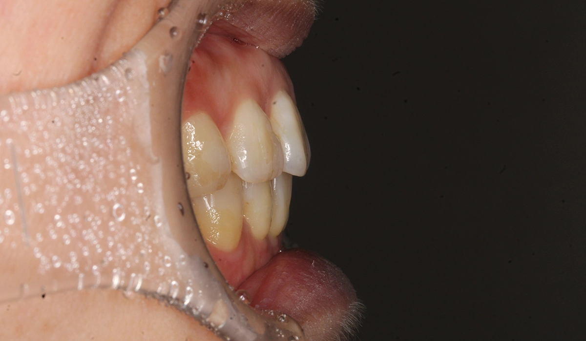 術後:オーバージェット