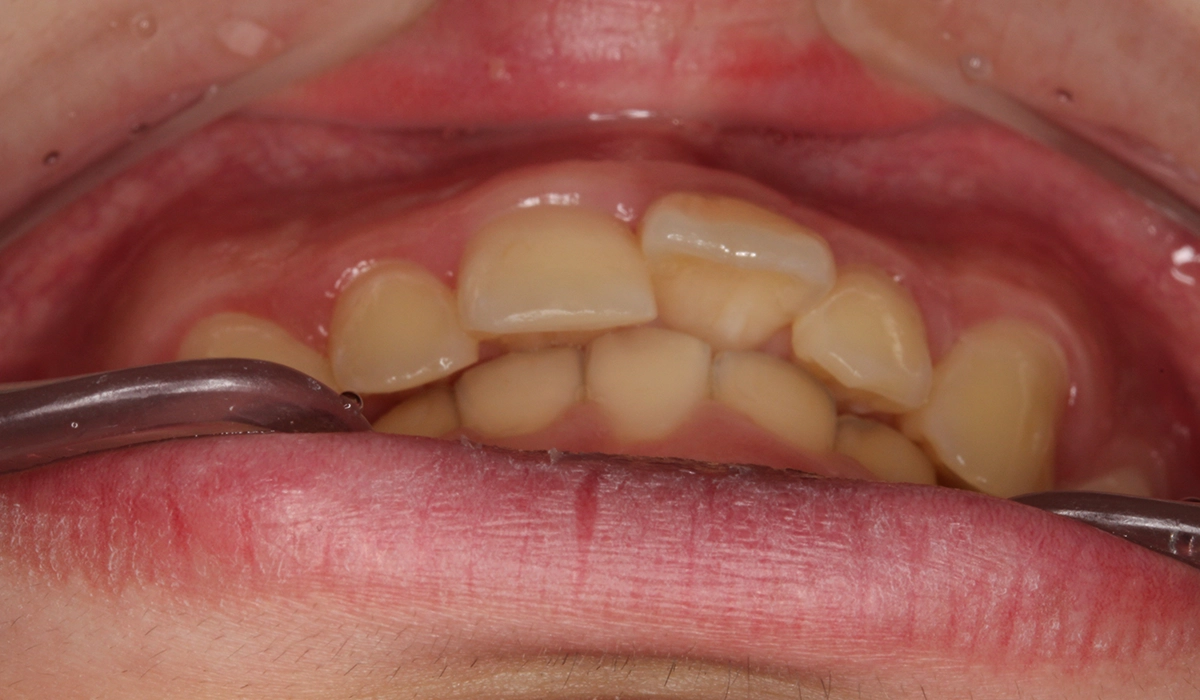 術前:前歯部あおり