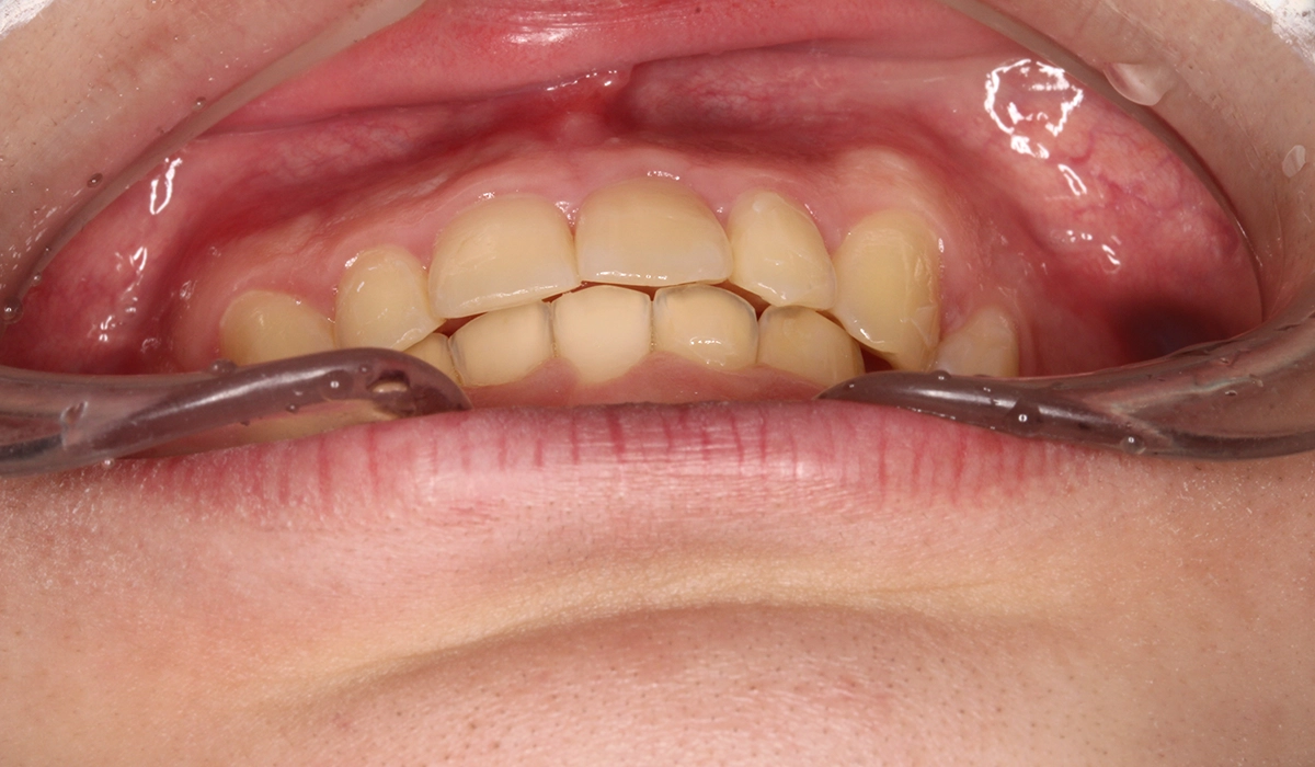 術後:前歯部あおり