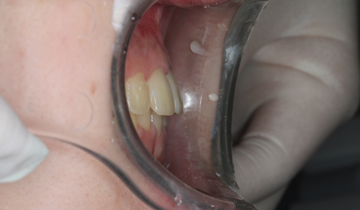 術後:オーバージェット