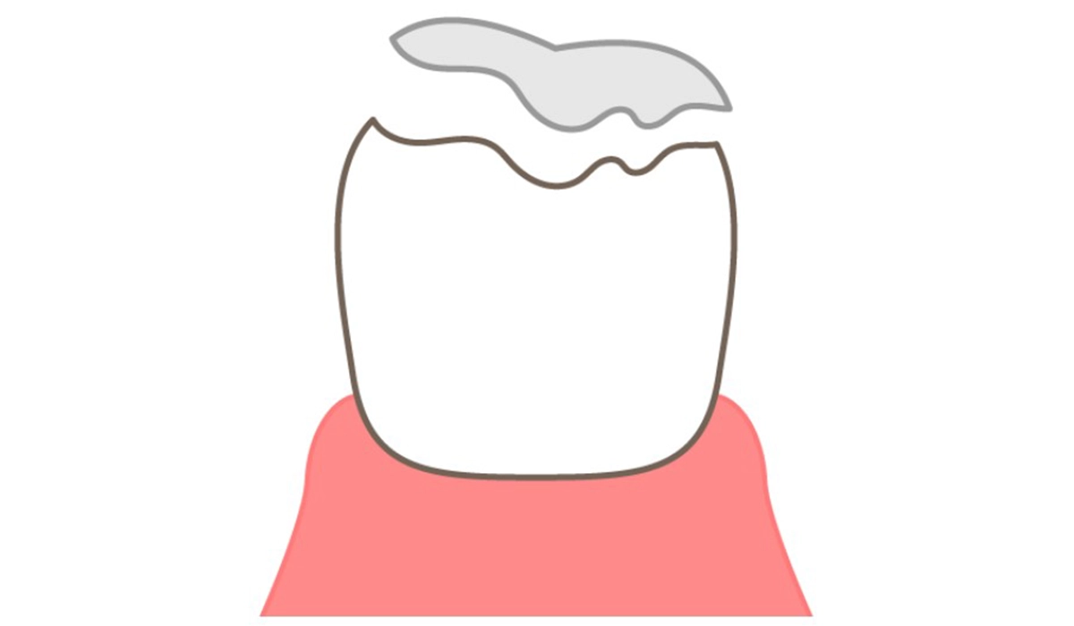 詰め物が取れやすくなる