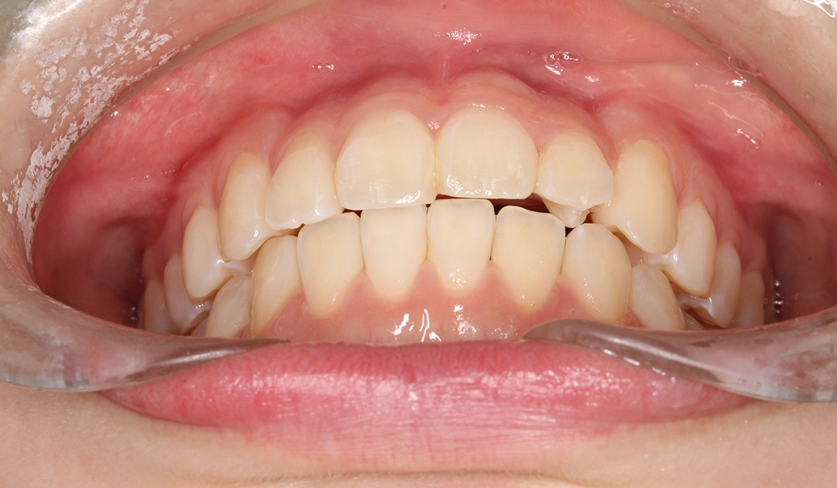 術後:前歯部あおり