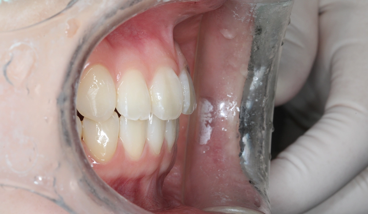 術後:オーバージェット