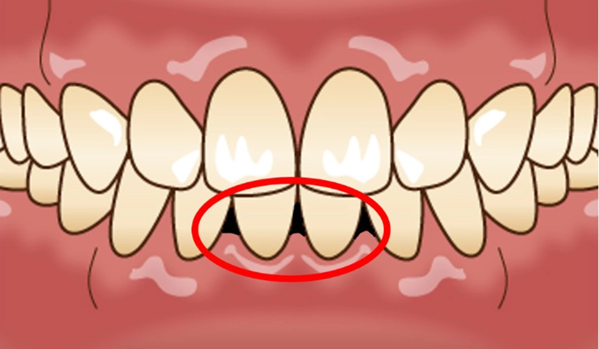 ブラックトライアングル