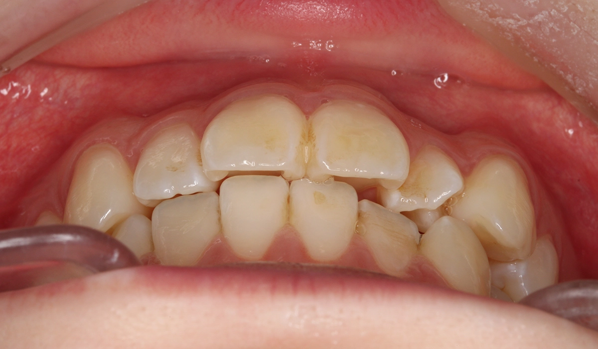 術前:前歯部あおり