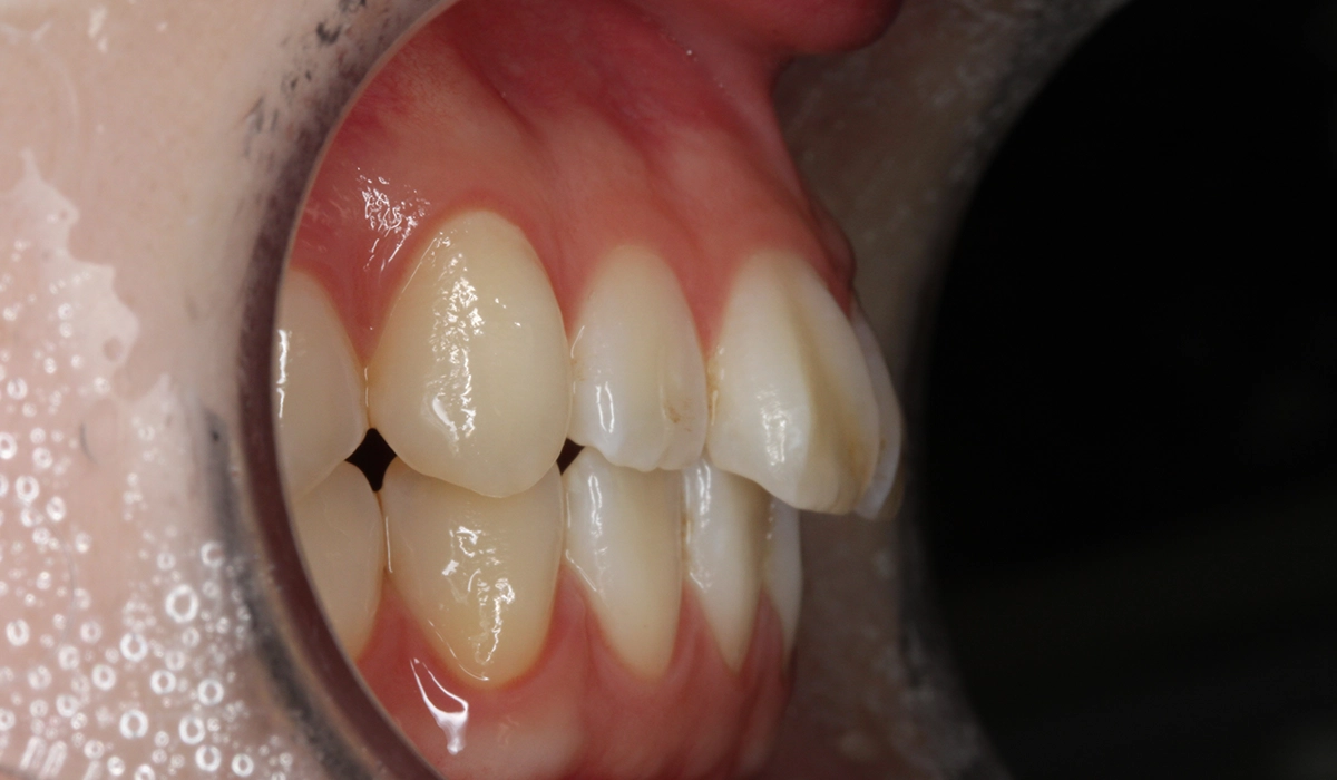 術前:オーバージェット