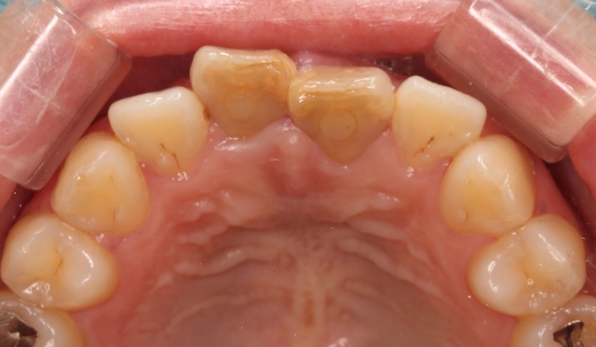 術前:上顎前歯部寄り