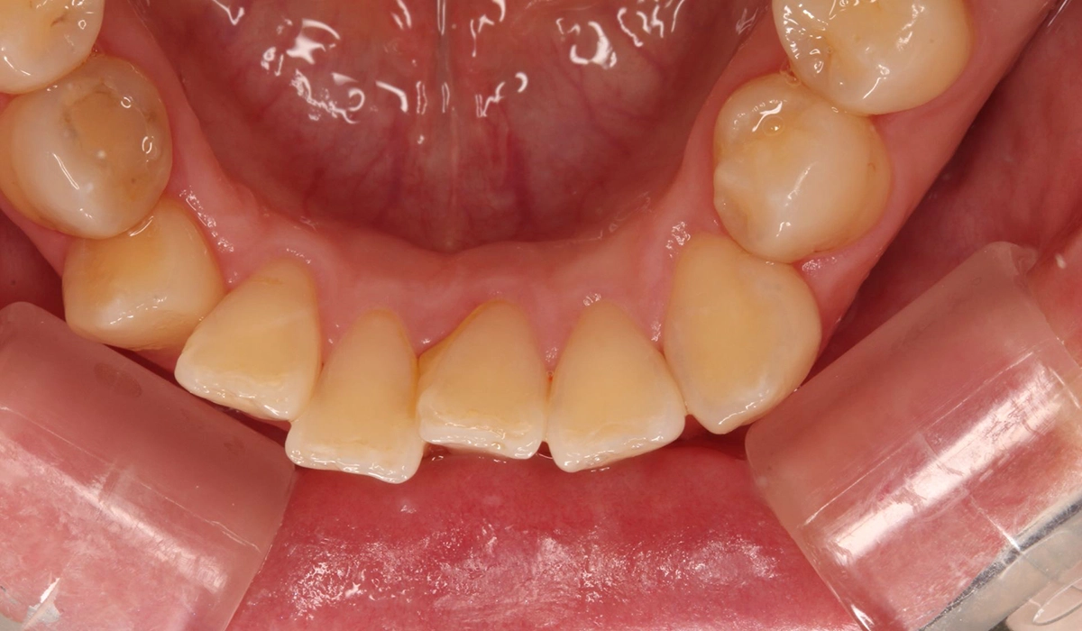 術前:下顎前歯部寄り