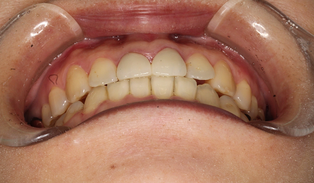 術後:前歯部あおり