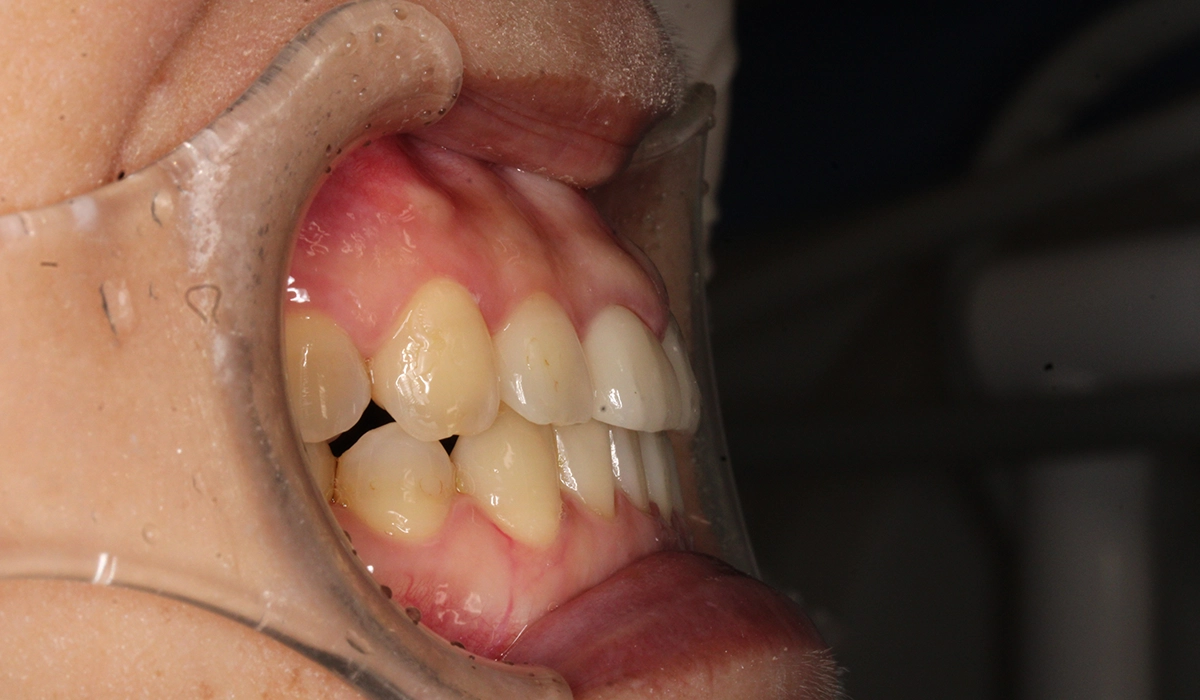 術後:オーバージェット