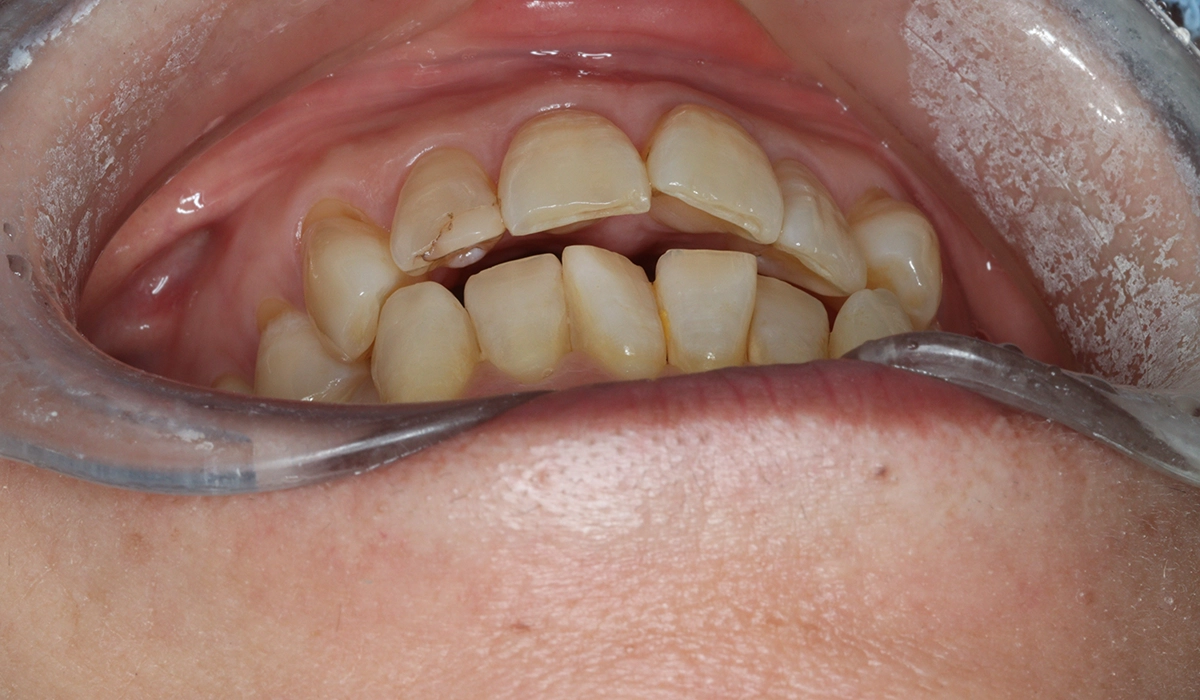 術前:前歯部あおり