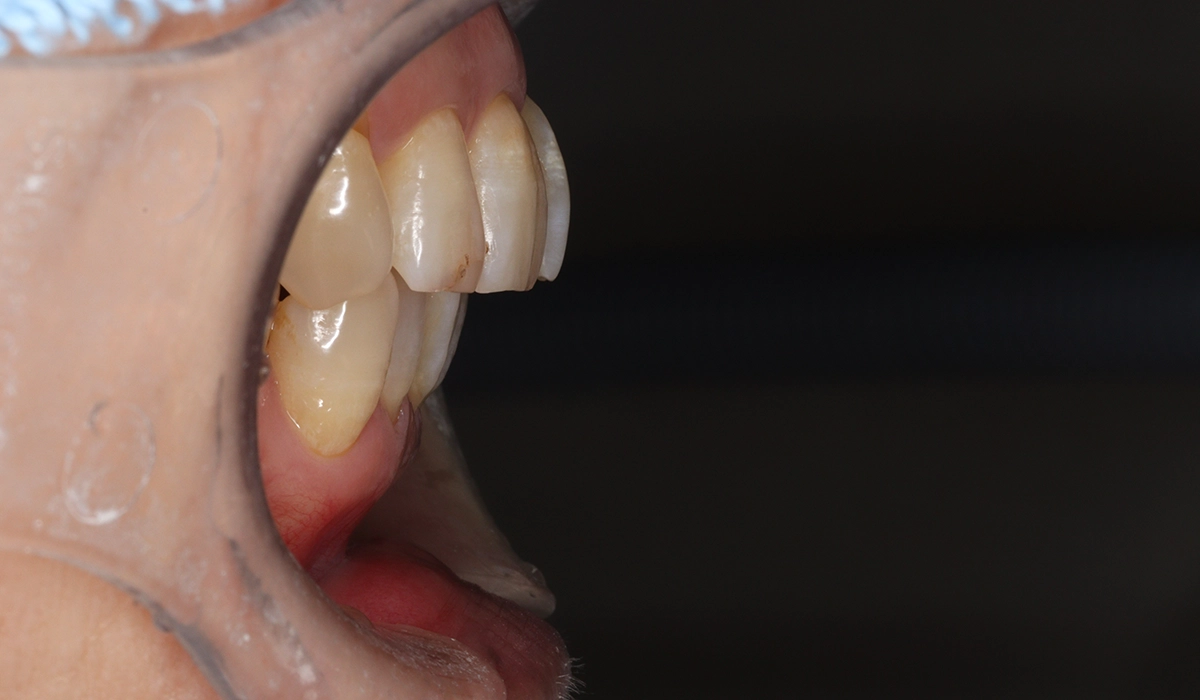 術前:オーバージェット