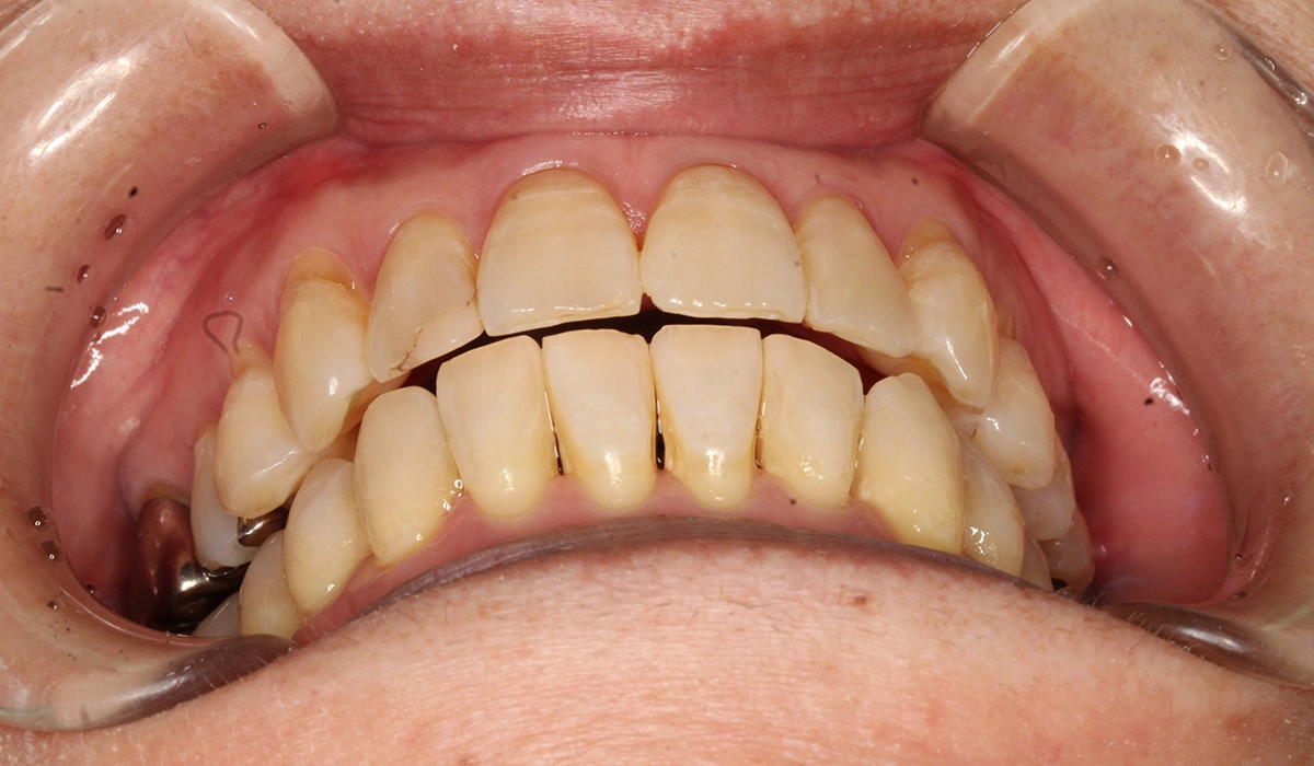 術後:前歯部あおり