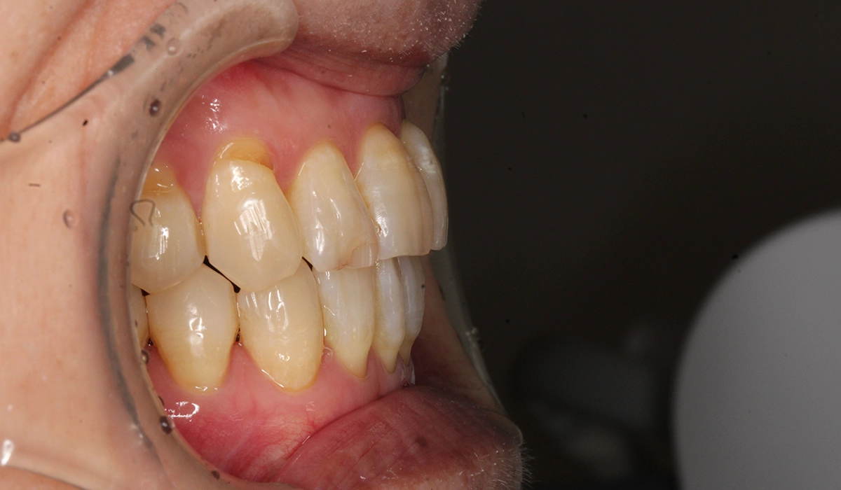 術後:オーバージェット