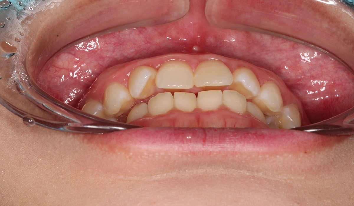 術前:前歯部あおり